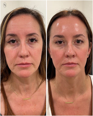 Smoshes™ Retinal Shot 0.1% Anti-edad Clinico + 1 GRATIS