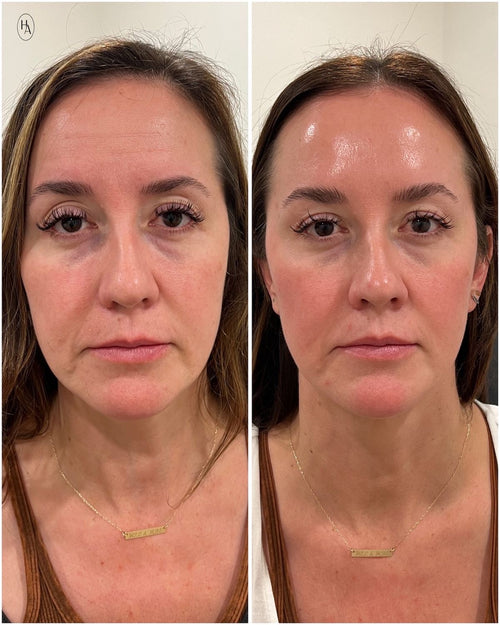 Smoshes™ Retinal Shot 0.1% Anti-edad Clinico + 1 GRATIS