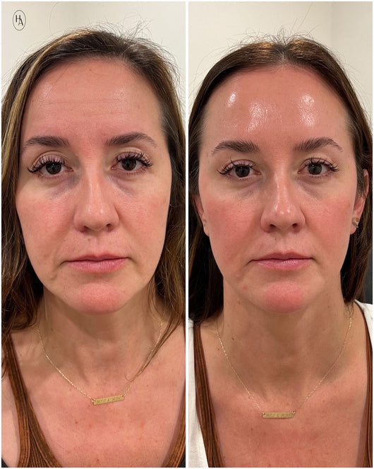 Smoshes™ Retinal Shot 0.1% Anti-edad Clinico + 1 GRATIS